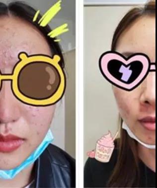 每天一杯奶茶杭州俩闺蜜同时满脸长痘：糖、奶摄入过多