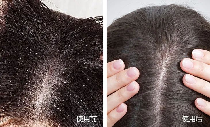 83岁泰斗再创业,研发养发方子止痒去屑,防掉发