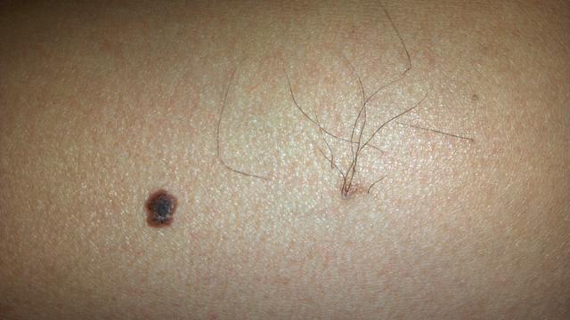 皮肤会长出"怪东西",当心肝脏有问题,要警惕|肝脏|蜘蛛痣|皮肤_新浪