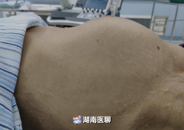 八旬老太腹内隆起似孕肚手术卸货重达6斤比篮球还大