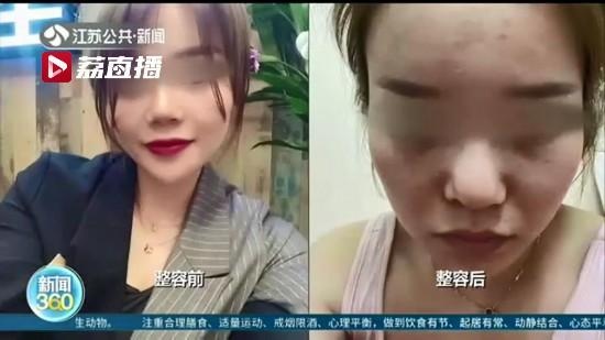 女子在南京韩辰整形医院花了两万多整形后鼻子歪