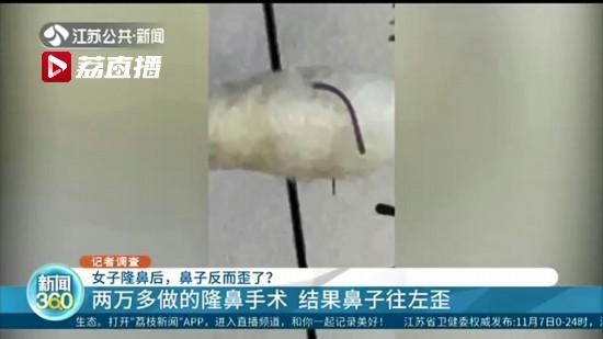 女子在南京韩辰整形医院花了两万多整形后鼻子歪了(图3)