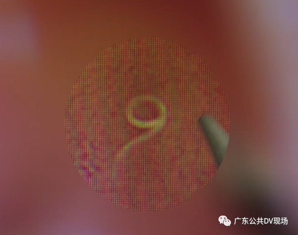 男子屁股奇痒无比原来是寄生虫在作妖