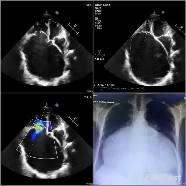 右心室肥大,太可怕了,单单高血压恐怕难以达到这样的程度