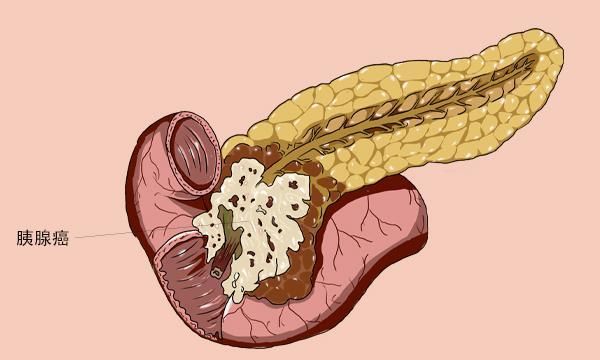 慢性胰腺炎发展成胰腺癌的可能性大吗医生不隐瞒地给出分析