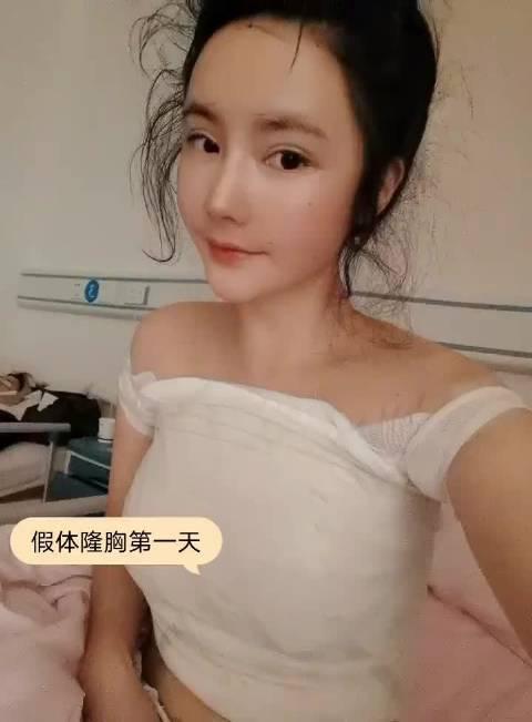 假体隆胸第一天 我是哺乳后胸干瘪 导致本来不大的胸更小了