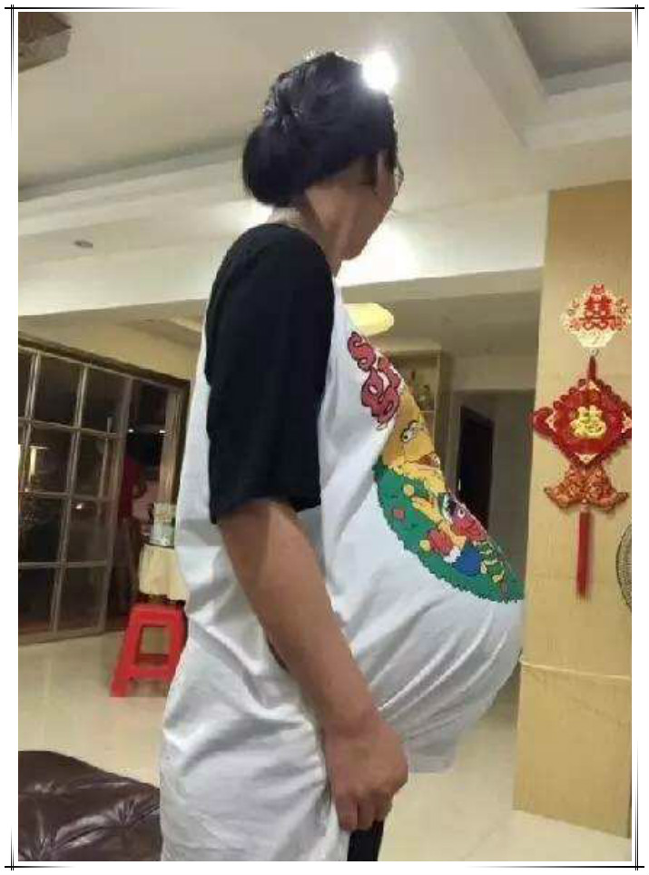 孕妇"悬垂肚"走红,网友猜测是"双胞胎":没见过这样的孕肚
