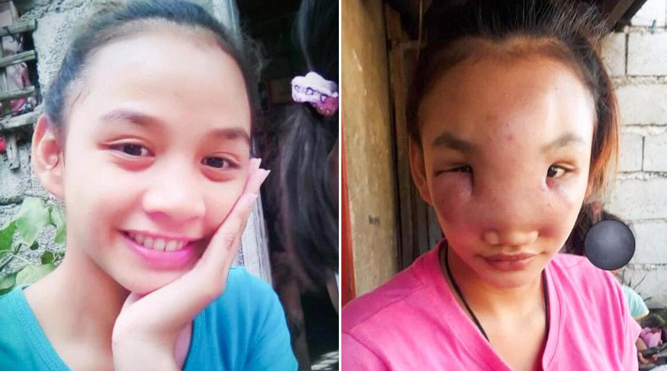 菲律宾17岁年轻妈妈脸上生出神秘肿块