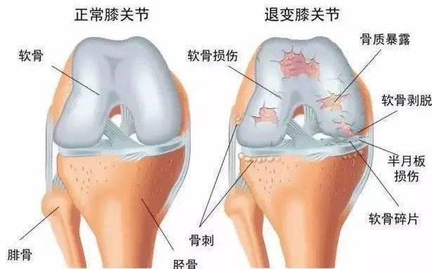 白酒搭配它,专治滑膜炎!再配一妙方,膝盖不疼了,积液也没了
