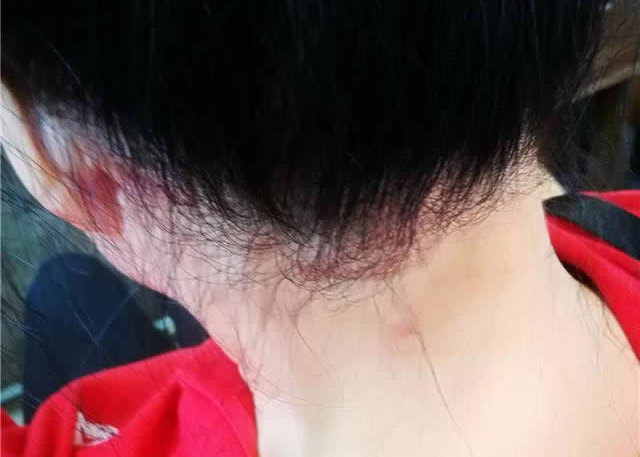 广西一女士称染发后得皮炎 美发店拒绝对其进行赔偿