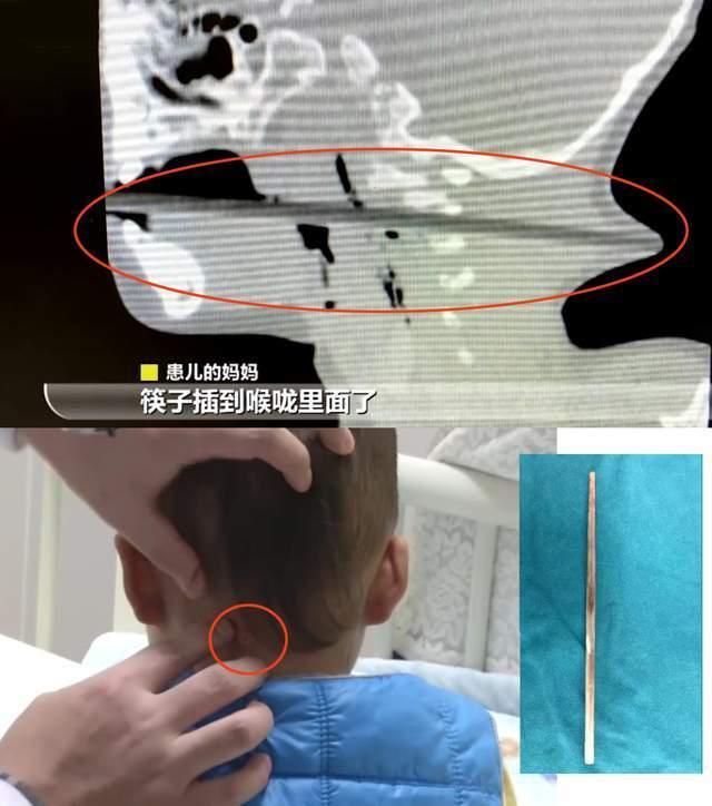 2岁幼童边吃边玩,摔倒被筷子戳穿颈部,网友:隔屏幕都觉得疼