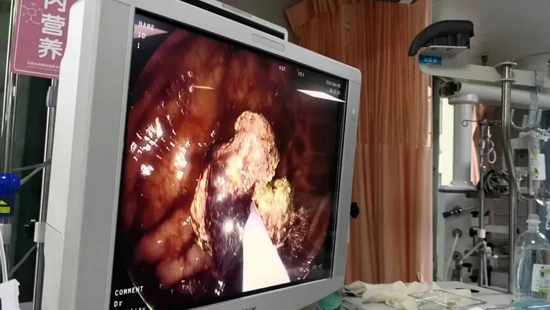 青岛大叔生命垂危,胃里"长满石头"!元凶竟是常见的