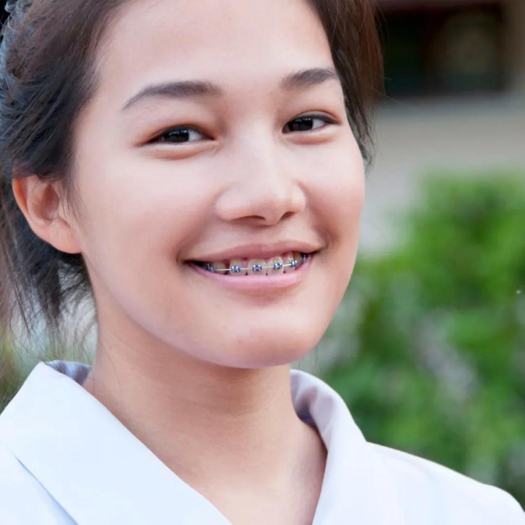 你的钢牙真可爱泰国人就爱戴牙套原因找到了