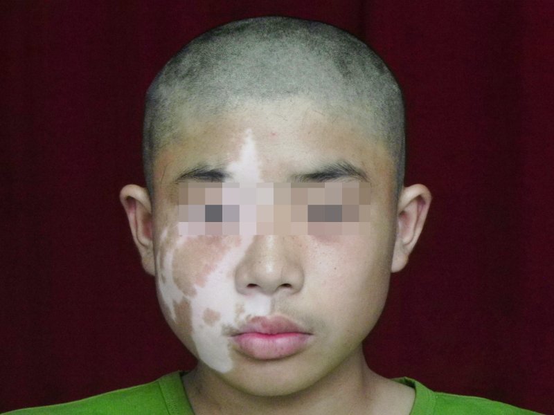 面部白癜风患者牛传明治疗前