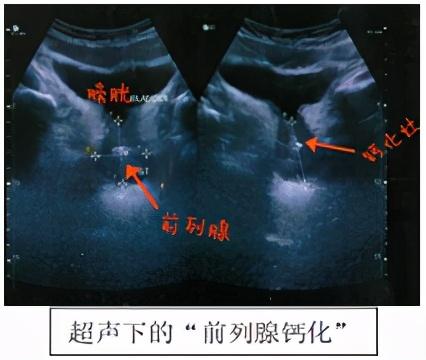 体检报告上出现前列腺钙化是咋回事听听专家的解读