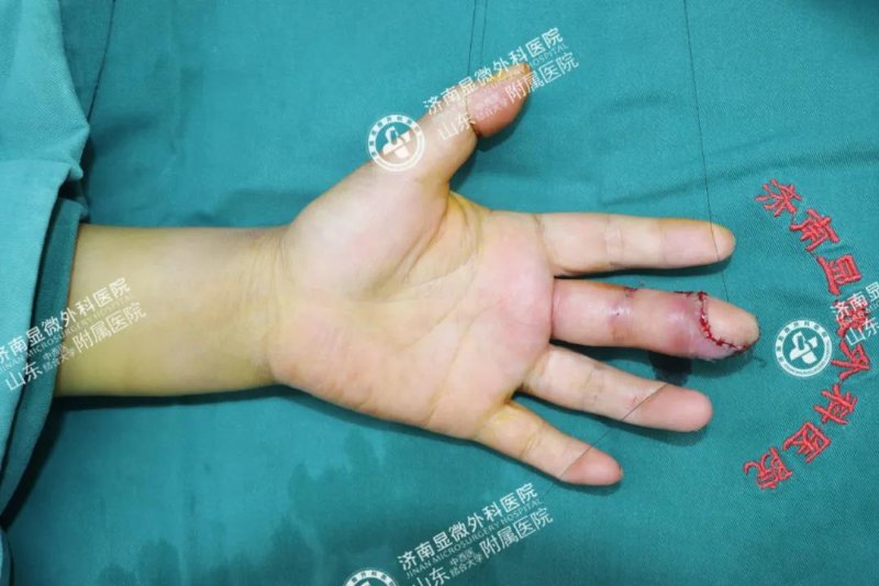 全国各地患者慕名而来,这个3d全形手指再造技术到底有多神奇?