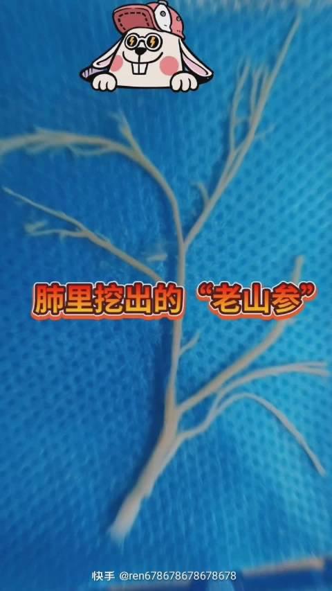 那些年肺里挖出的痰栓_新浪新闻