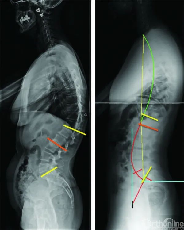 从4种腰椎前凸临界点探寻腰椎退变过程