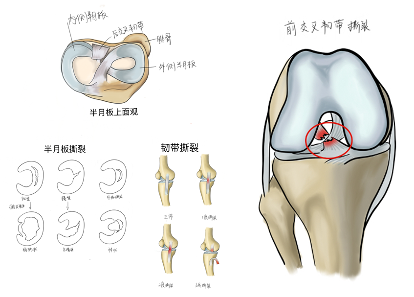 下膝关节的结构,我们可以这样简单记忆:它主要由一条肌腱,两个半月板