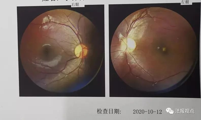 短短几秒，孩子瞎了，永久的！