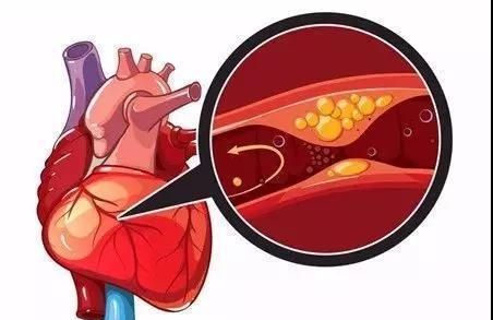 有了冠心病,对寿命的影响有多大?如何才能让这种影响最小化?