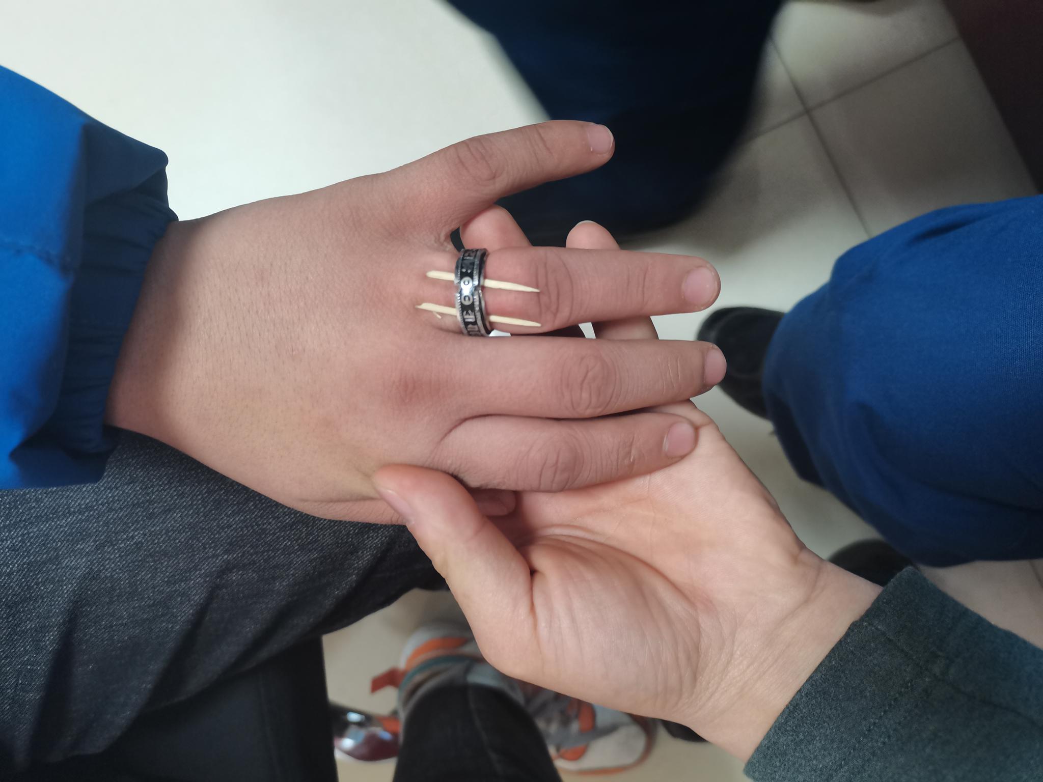 高中生戒指卡手致肿胀,吴忠消防成功"破戒"