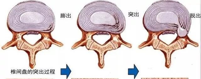 腰椎间盘突出中央型图图片