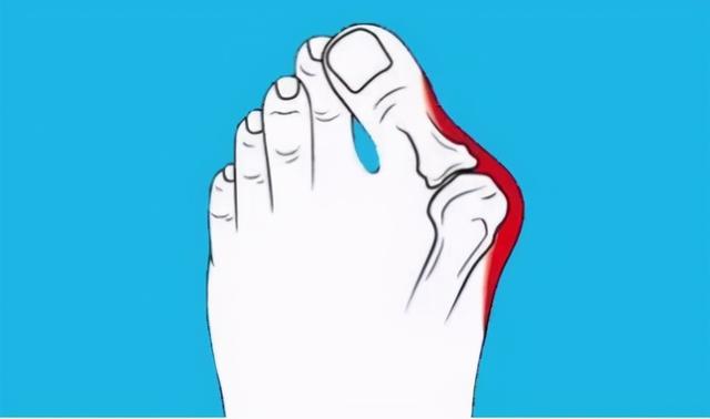 不穿高跟鞋怎么也得这病?珠海一男子踇外翻30余年