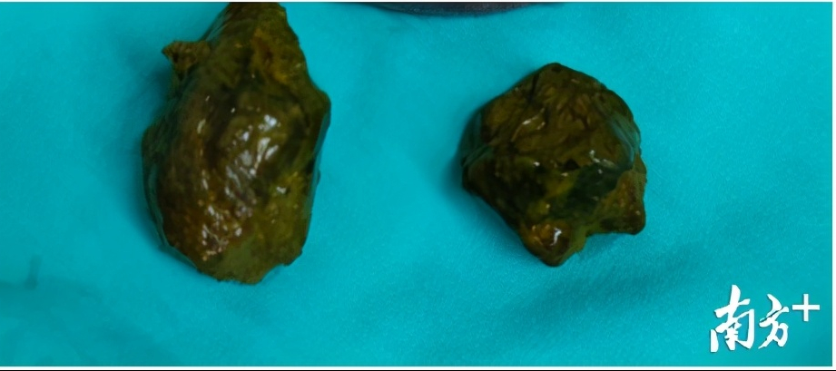 89岁阿婆空腹食柿致肠梗阻中山六院行腹腔镜取出两枚粪石获治