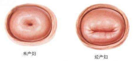 慢性宫颈炎的症状和急性宫颈炎类似,同样是除了白带增多和接触性出血