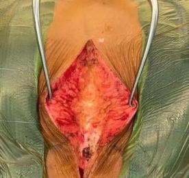 疾病都是有发展过程的,若"富贵包"还在初期,只是颈