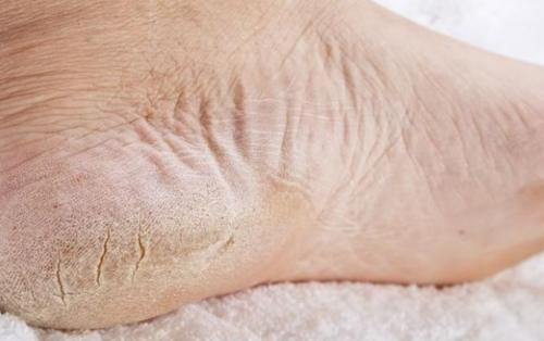 又臭又痒不敢拖鞋,几个原因你清楚吗?|脚气|脚气病|真菌_新浪新闻