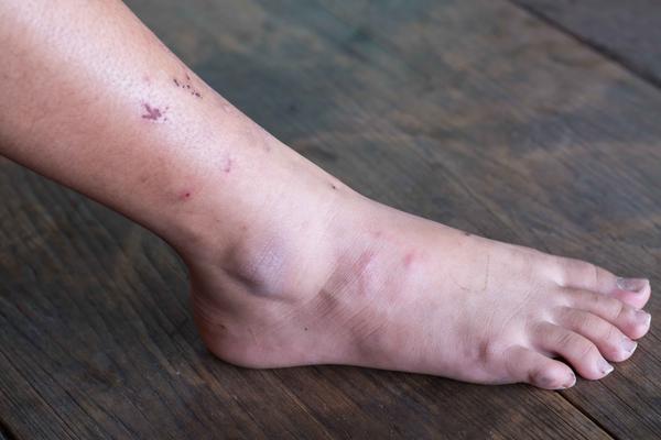 糖尿病患者不想糖尿病足找上门早期5个症状需留心观察