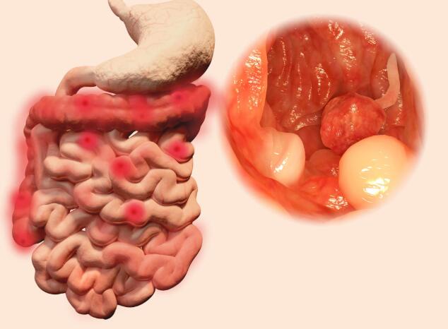 痔疮与肠癌便血的区别,要清楚|肠癌|痔疮|大便_新浪新闻
