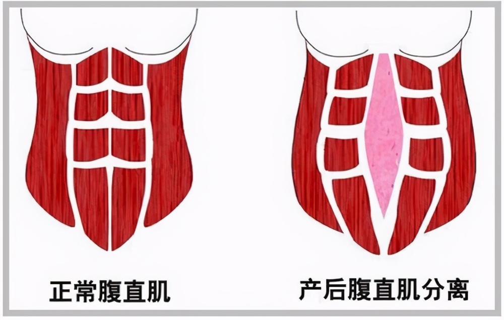 仰卧起坐|腹直肌|产妇_新浪新闻