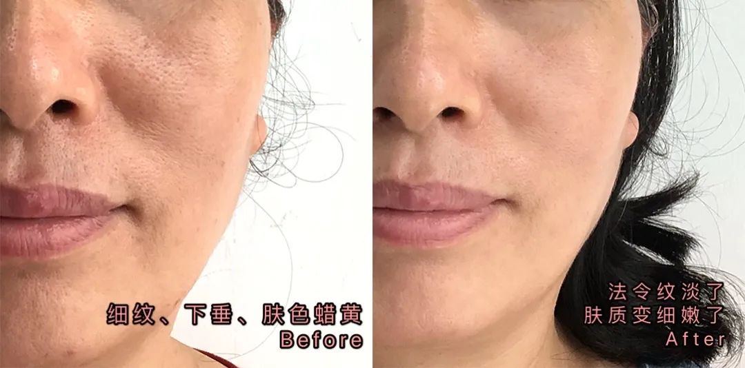 果然贵有贵的道理,最近加班熬出来的小细纹,蜡黄脸都变嫩了,闺蜜以为