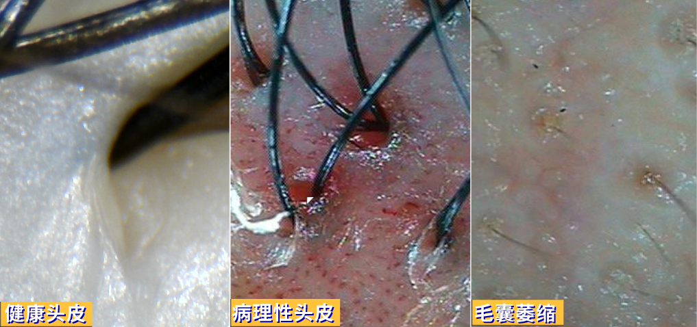 到专业毛发机构进行毛发镜检查,从皮内(毛囊情况),皮上(头皮情况),皮