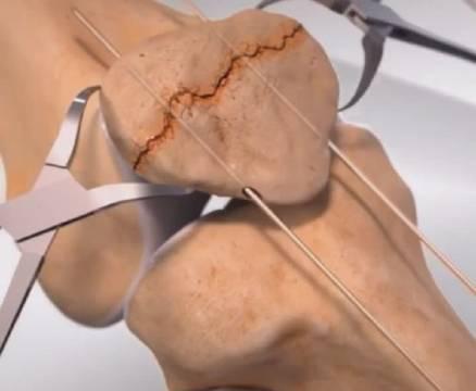 髌骨骨折手术演示