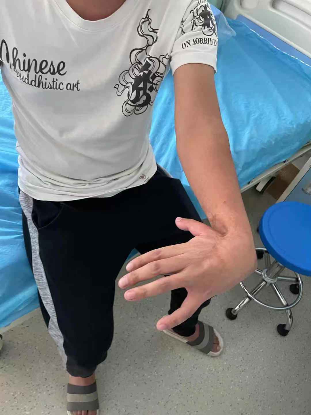 术后的他很激动,手腕畸形弯曲90度终于消失了!