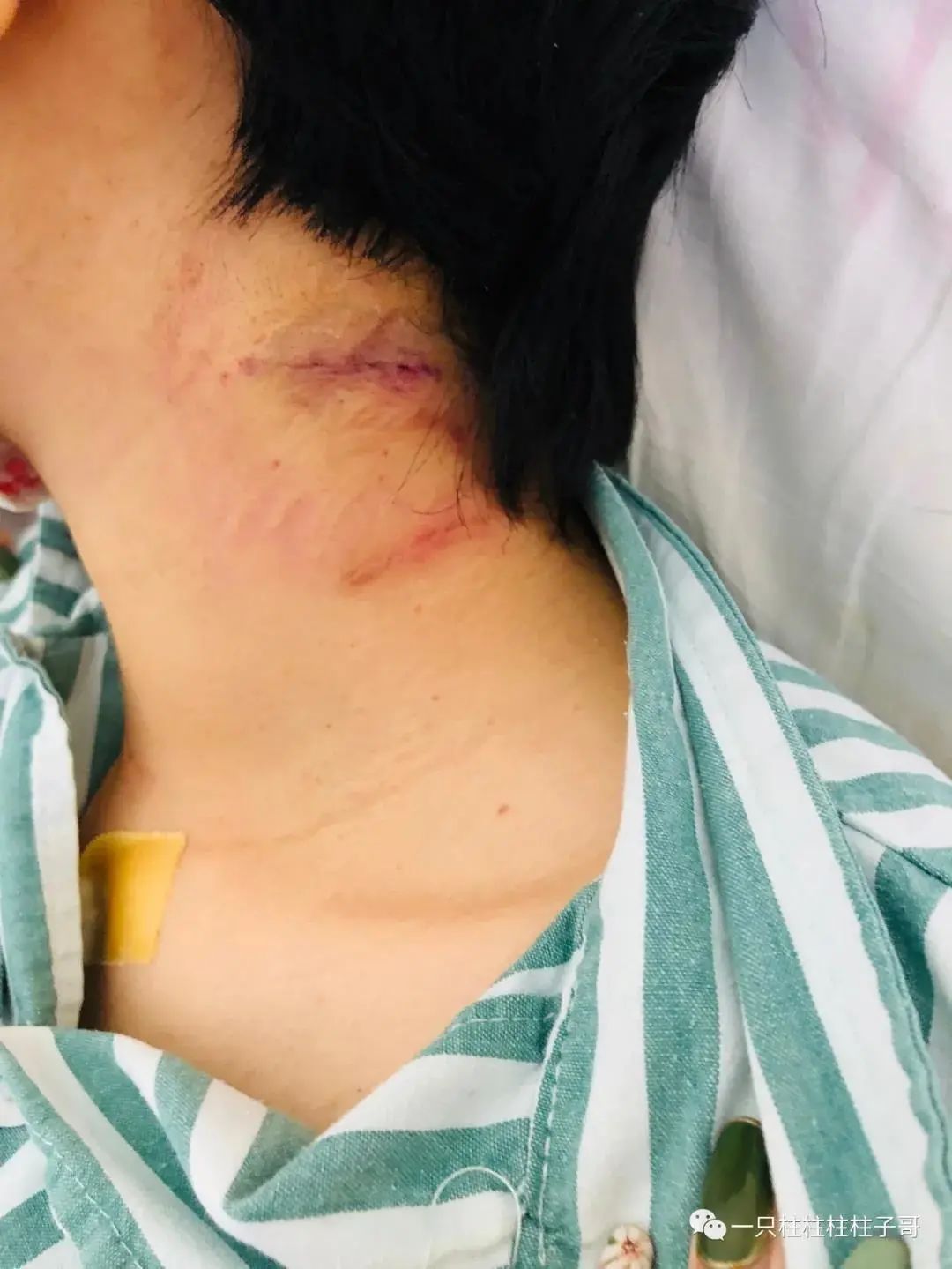 柱子哥做手术留下的5厘米刀口伤疤.受访者供图