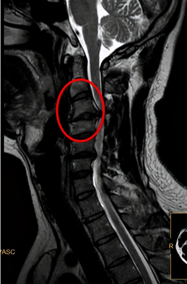 "26岁的年纪,60岁的颈椎"广东小伙因手脚发麻就医,却发现差点瘫痪