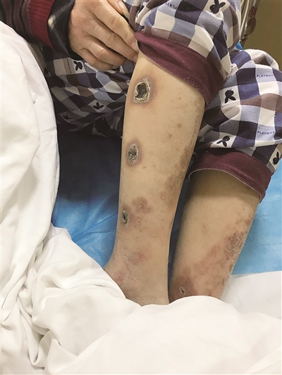 张先生春节前在柳石路一家叫"本治中医诊所"的小诊所做艾灸却被烫伤