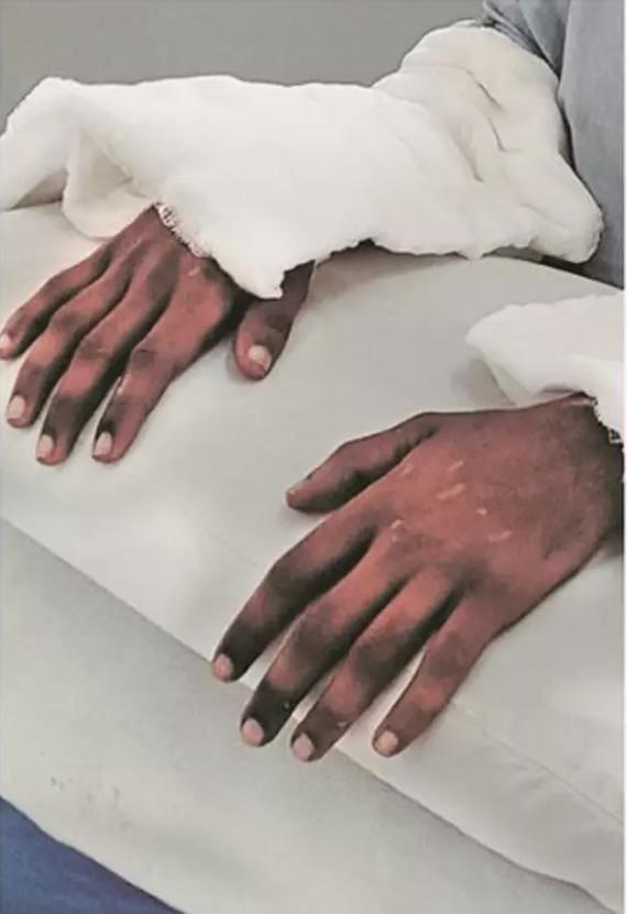 印度少女移植男性黝黑双手肤色神奇变白嫩滑无毛如纤纤玉手