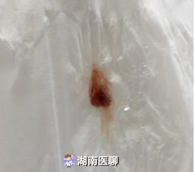 女童咳出铁锈色痰液!检查发现疑似"新肺",医生却说虚惊一场?