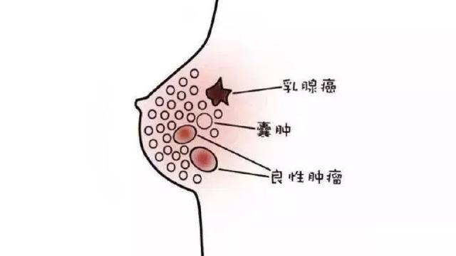 乳腺结节怎么回事图片