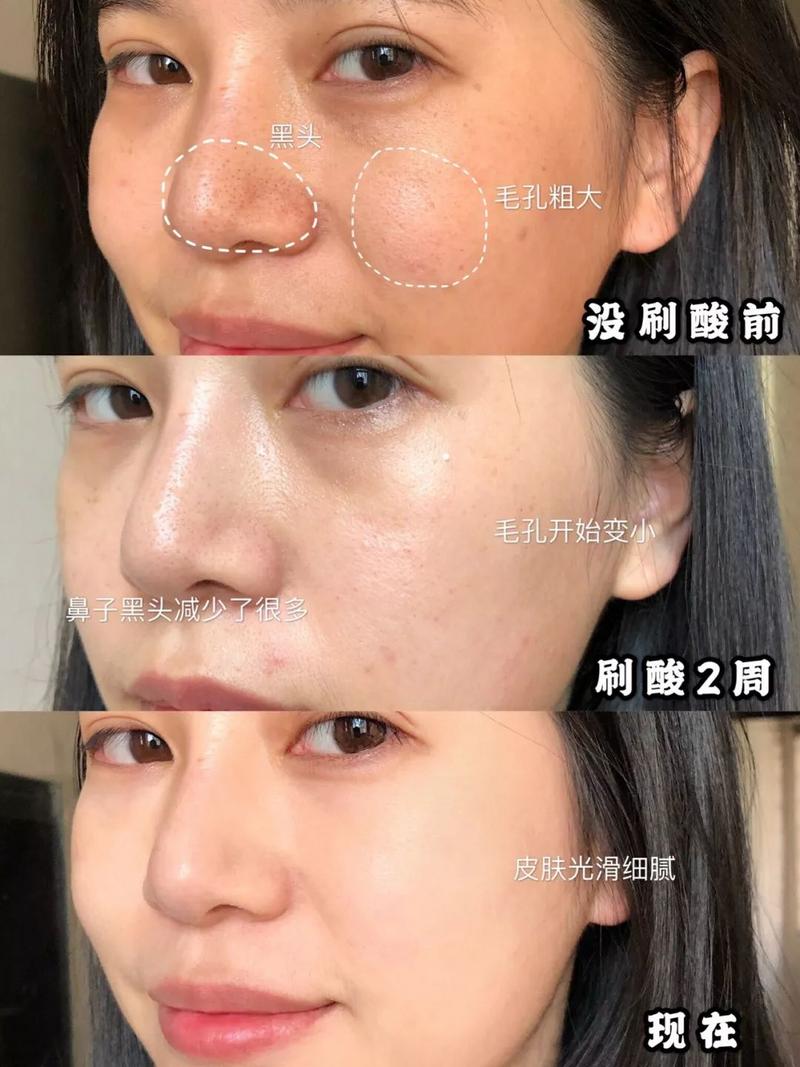 抖音流行的换脸大法「刷酸」,试了一次我就后悔了!