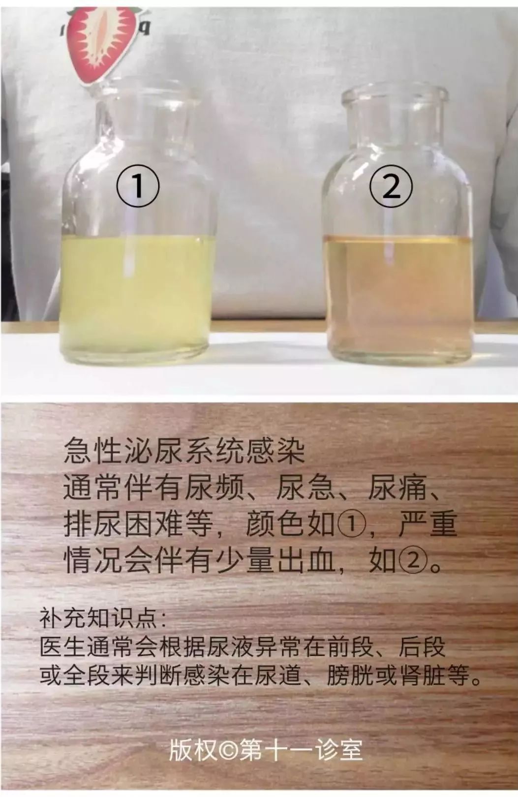 老六还给大家补充一些比较不那么常见的颜色:白色混浊乳白色的乳糜尿