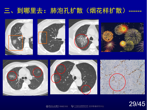 赵振军:最全图文解读《新冠肺炎ct早期诊断和鉴别诊断》(下)