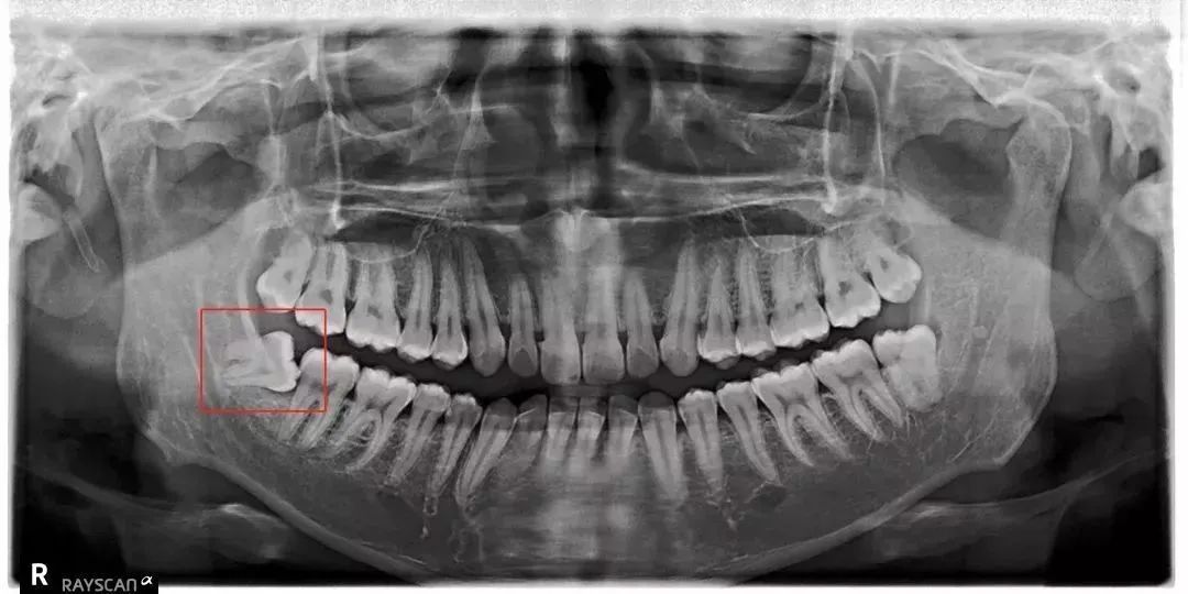 对智齿仁慈就是对自己残忍