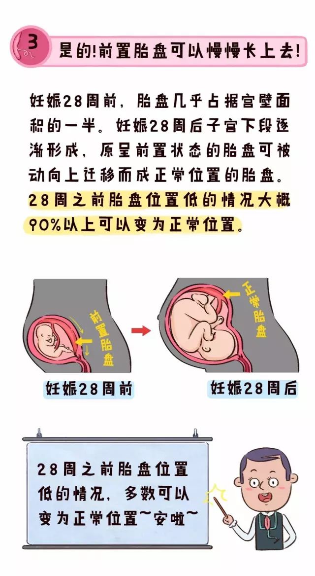 宫缩等严重的情况,就还是老话:叨叨:前置胎盘可以上去的几率又是多少